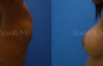 Breast Augmentation Before and After | Sayah Institute