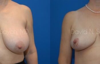 Breast Reduction Before and After | Sayah Institute