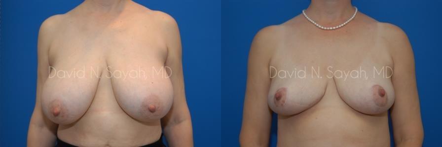 Breast Reduction Before and After | Sayah Institute