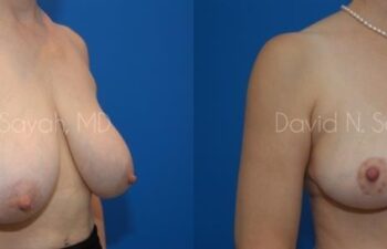 Breast Reduction Before and After | Sayah Institute