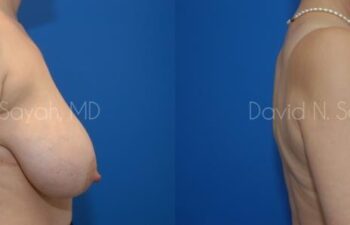 Breast Reduction Before and After | Sayah Institute