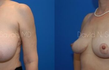 Breast Reduction Before and After | Sayah Institute