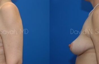 Breast Reduction Before and After | Sayah Institute