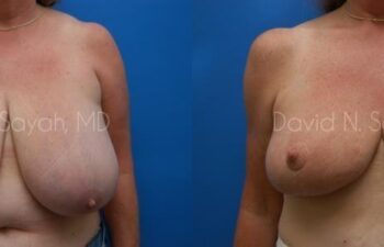 Breast Reduction Before and After | Sayah Institute
