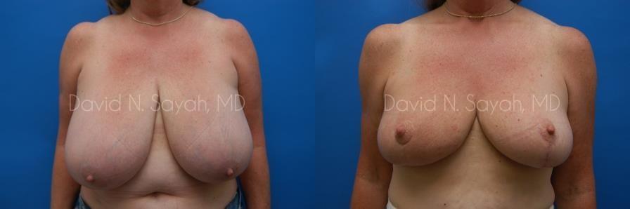 Breast Reduction Before and After | Sayah Institute