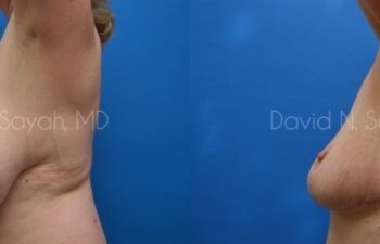 Breast Reduction Before and After | Sayah Institute