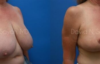 Breast Reduction Before and After | Sayah Institute