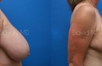 Breast Reduction Before and After | Sayah Institute