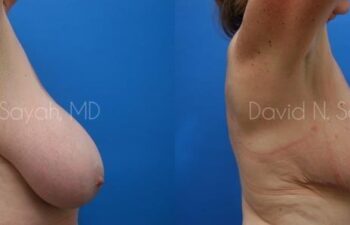 Breast Reduction Before and After | Sayah Institute