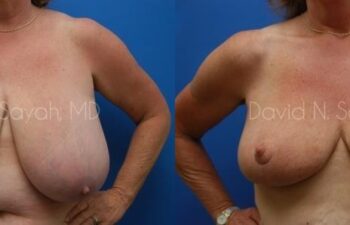 Breast Reduction Before and After | Sayah Institute