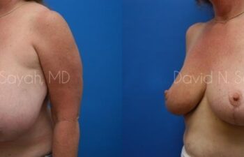 Breast Reduction Before and After | Sayah Institute