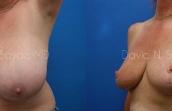 Breast Reduction Before and After | Sayah Institute
