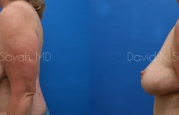 Breast Reduction Before and After | Sayah Institute