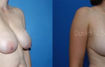 Breast Reduction Before and After | Sayah Institute