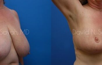 Breast Reduction Before and After | Sayah Institute
