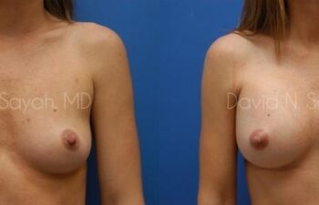 Breast Augmentation Before and After | Sayah Institute