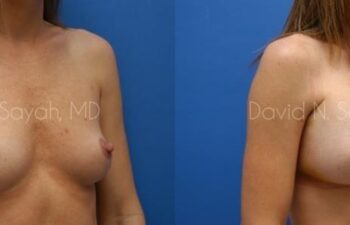 Breast Augmentation Before and After | Sayah Institute