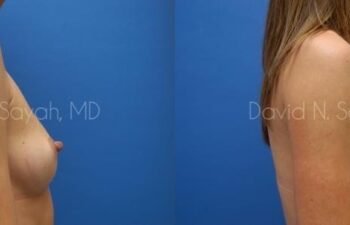 Breast Augmentation Before and After | Sayah Institute