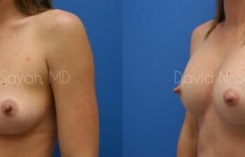 Breast Augmentation Before and After | Sayah Institute