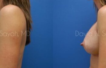 Breast Augmentation Before and After | Sayah Institute
