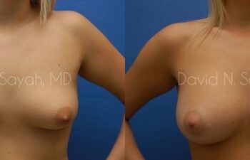 Breast Augmentation Before and After | Sayah Institute