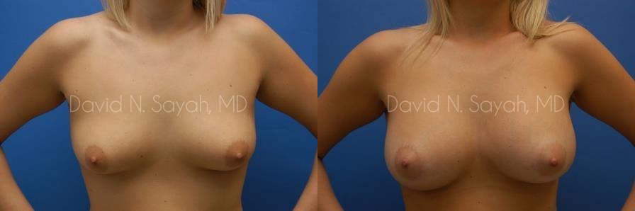 Breast Augmentation Before and After | Sayah Institute