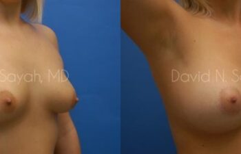 Breast Augmentation Before and After | Sayah Institute