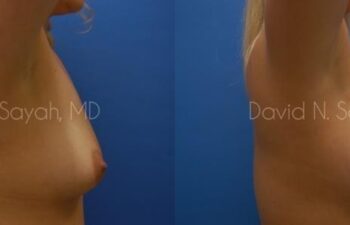 Breast Augmentation Before and After | Sayah Institute