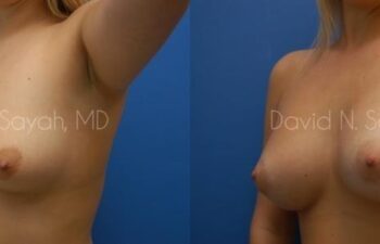 Breast Augmentation Before and After | Sayah Institute
