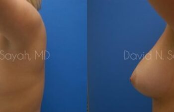 Breast Augmentation Before and After | Sayah Institute