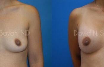 Breast Augmentation Before and After | Sayah Institute