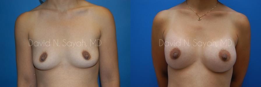 Breast Augmentation Before and After | Sayah Institute