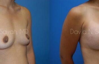 Breast Augmentation Before and After | Sayah Institute