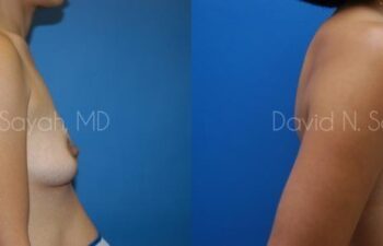 Breast Augmentation Before and After | Sayah Institute