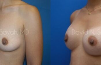 Breast Augmentation Before and After | Sayah Institute