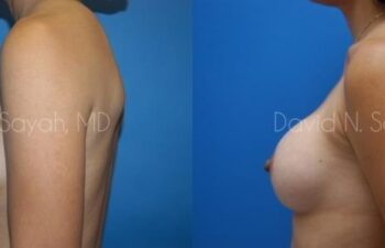 Breast Augmentation Before and After | Sayah Institute