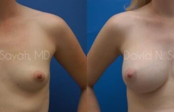 Breast Augmentation Before and After | Sayah Institute