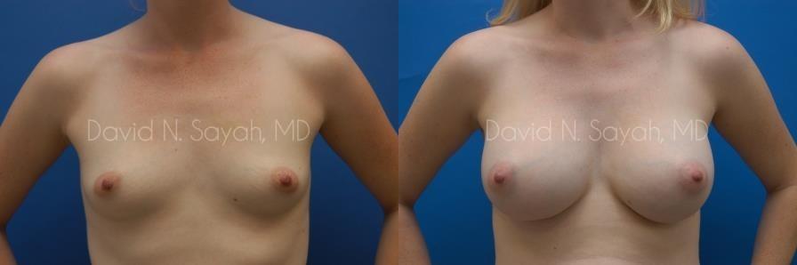 Breast Augmentation Before and After | Sayah Institute