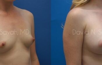 Breast Augmentation Before and After | Sayah Institute