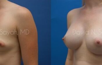 Breast Augmentation Before and After | Sayah Institute