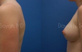 Breast Augmentation Before and After | Sayah Institute