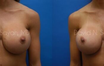 Breast Augmentation Before and After | Sayah Institute