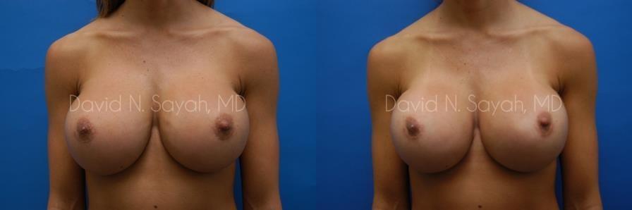 Breast Augmentation Before and After | Sayah Institute