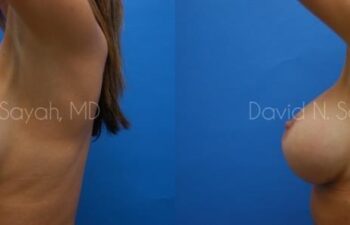 Breast Augmentation Before and After | Sayah Institute