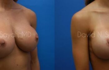 Breast Augmentation Before and After | Sayah Institute