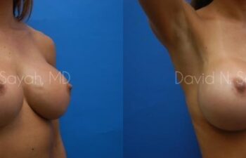 Breast Augmentation Before and After | Sayah Institute