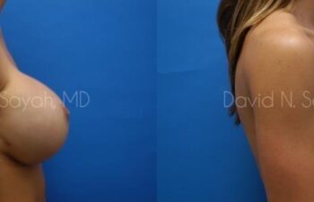 Breast Augmentation Before and After | Sayah Institute