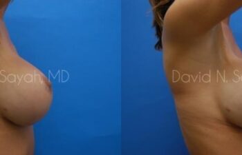 Breast Augmentation Before and After | Sayah Institute