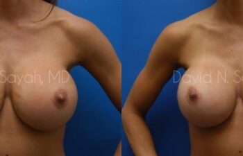 Breast Augmentation Before and After | Sayah Institute