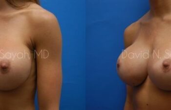 Breast Augmentation Before and After | Sayah Institute
